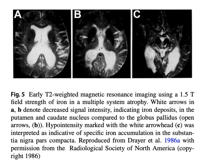 Brain imaging showing iron accumulation in dopamine producing centers