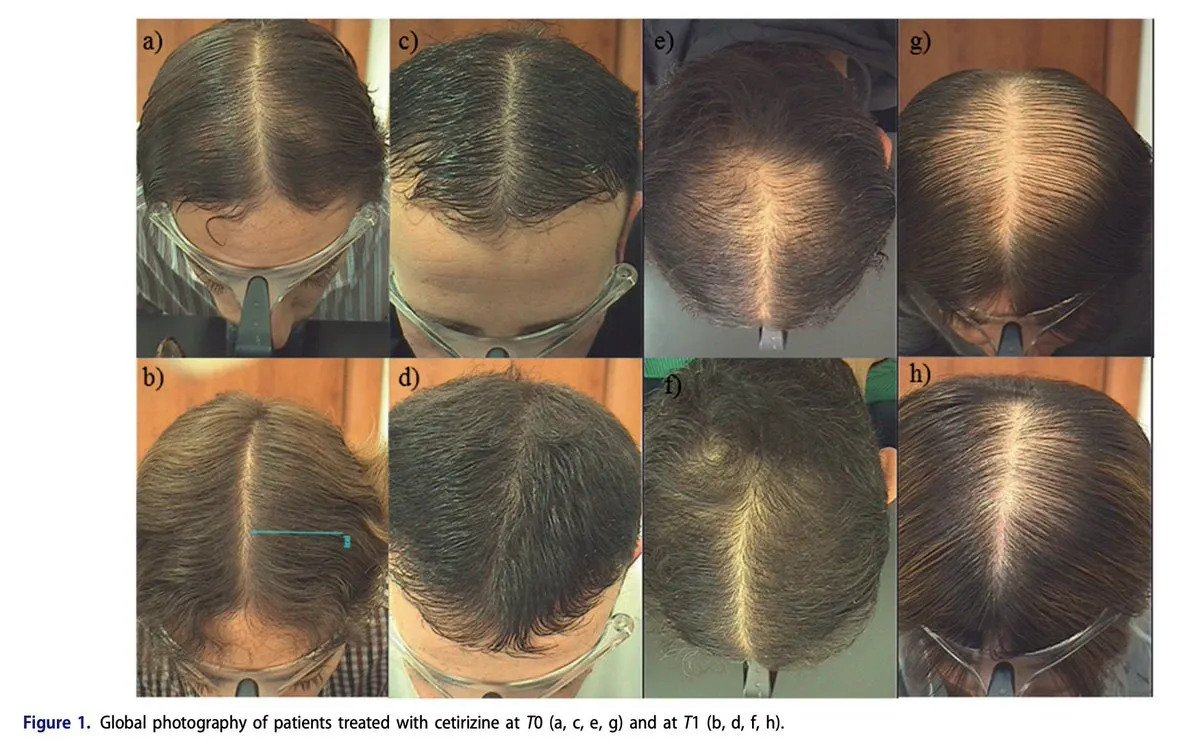 Overview of male pattern baldness as an inflammatory condition driven by histamine