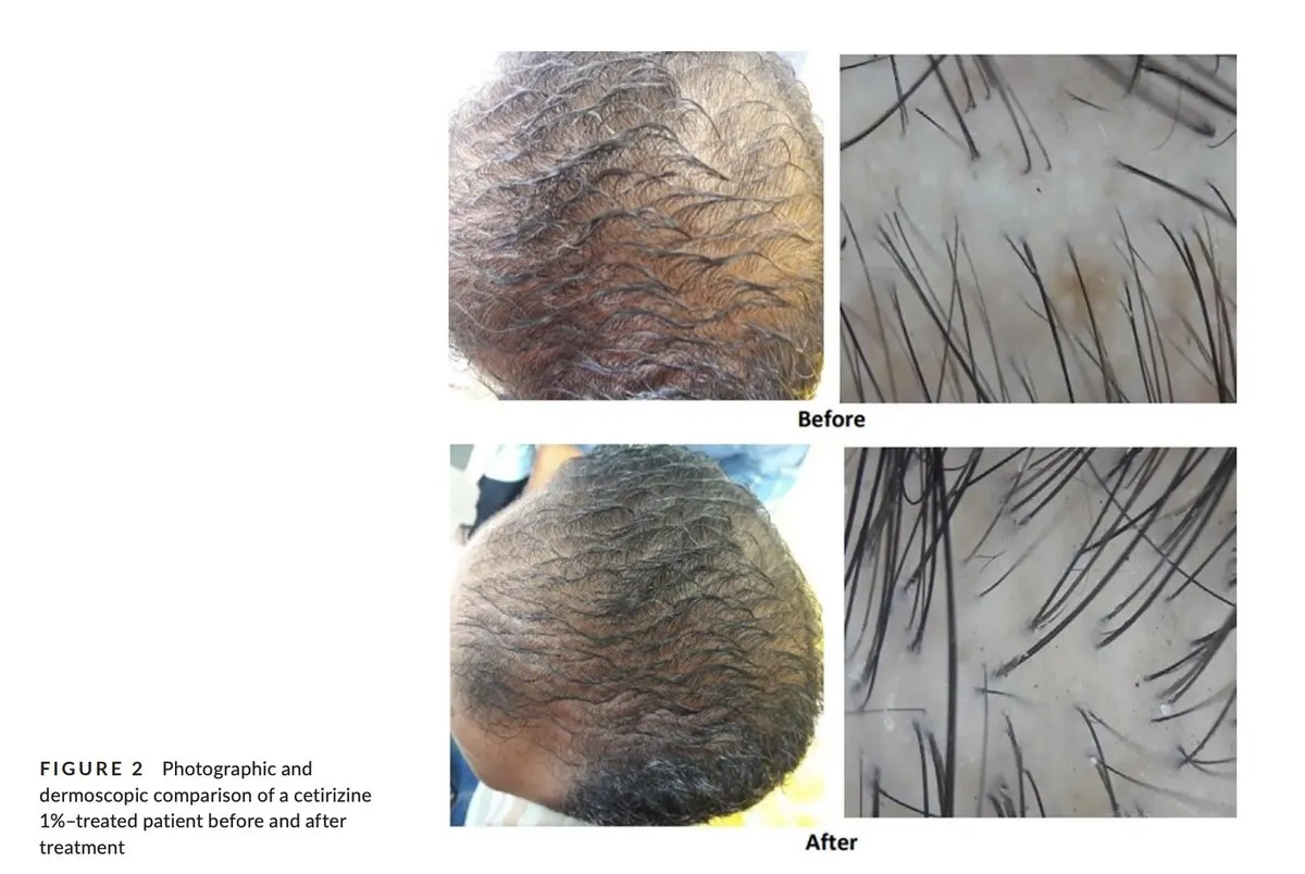 Follow-up study results comparing cetirizine group versus control group hair improvement rates