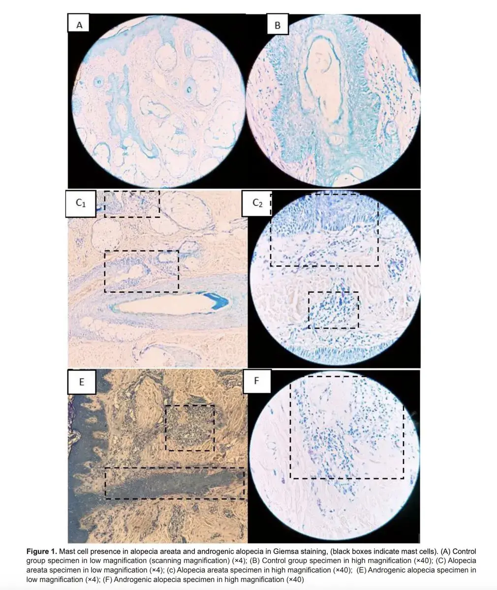 Comparison of mast cell density in balding versus healthy scalp tissue