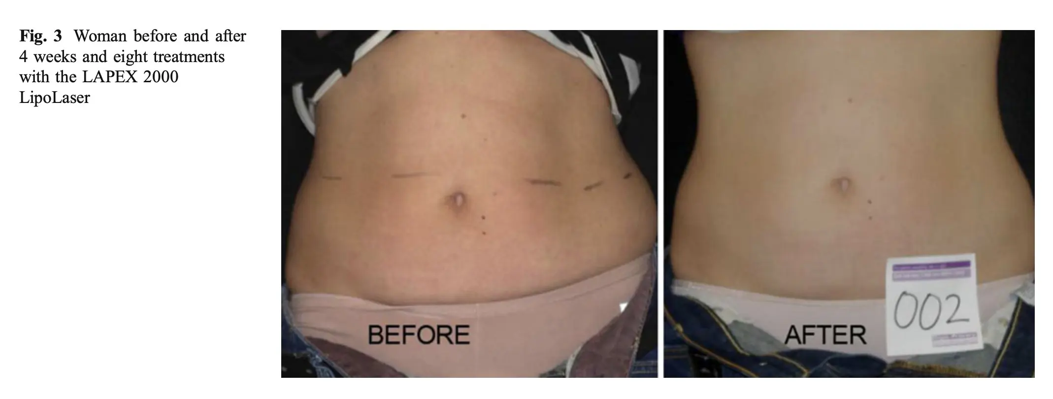 Before and after waistline of the best responder in the red laser therapy study