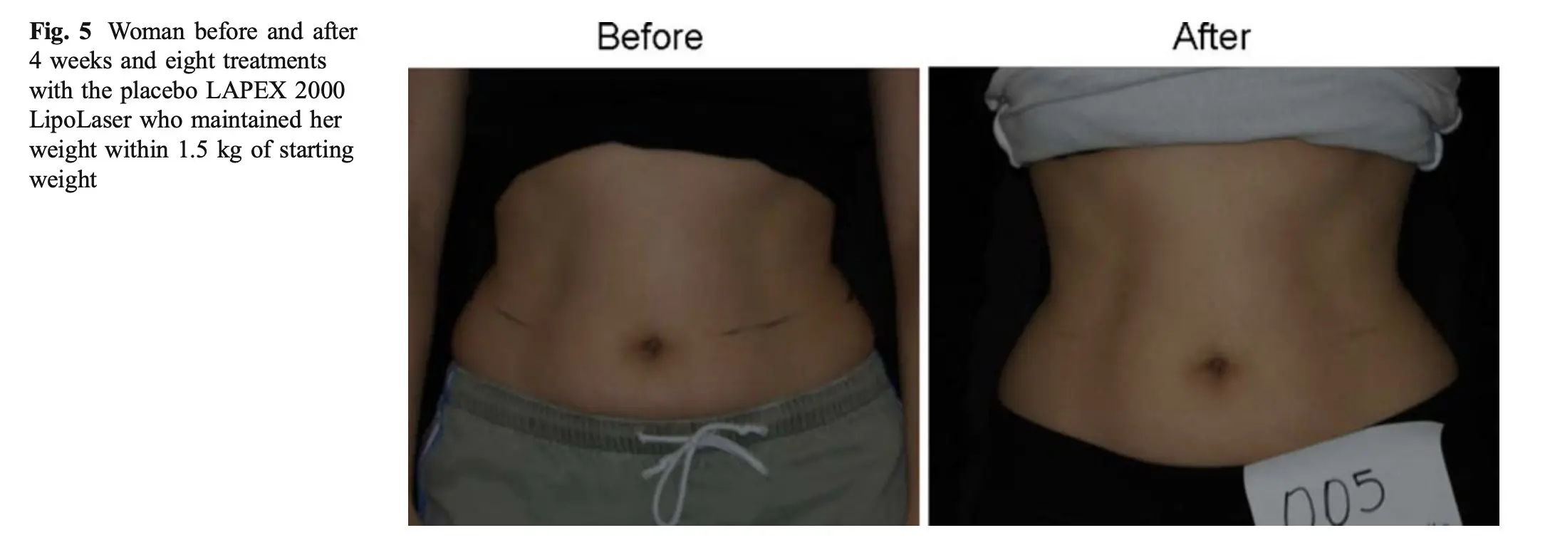 Another before and after example of the visual effect of red laser treatment on the waist