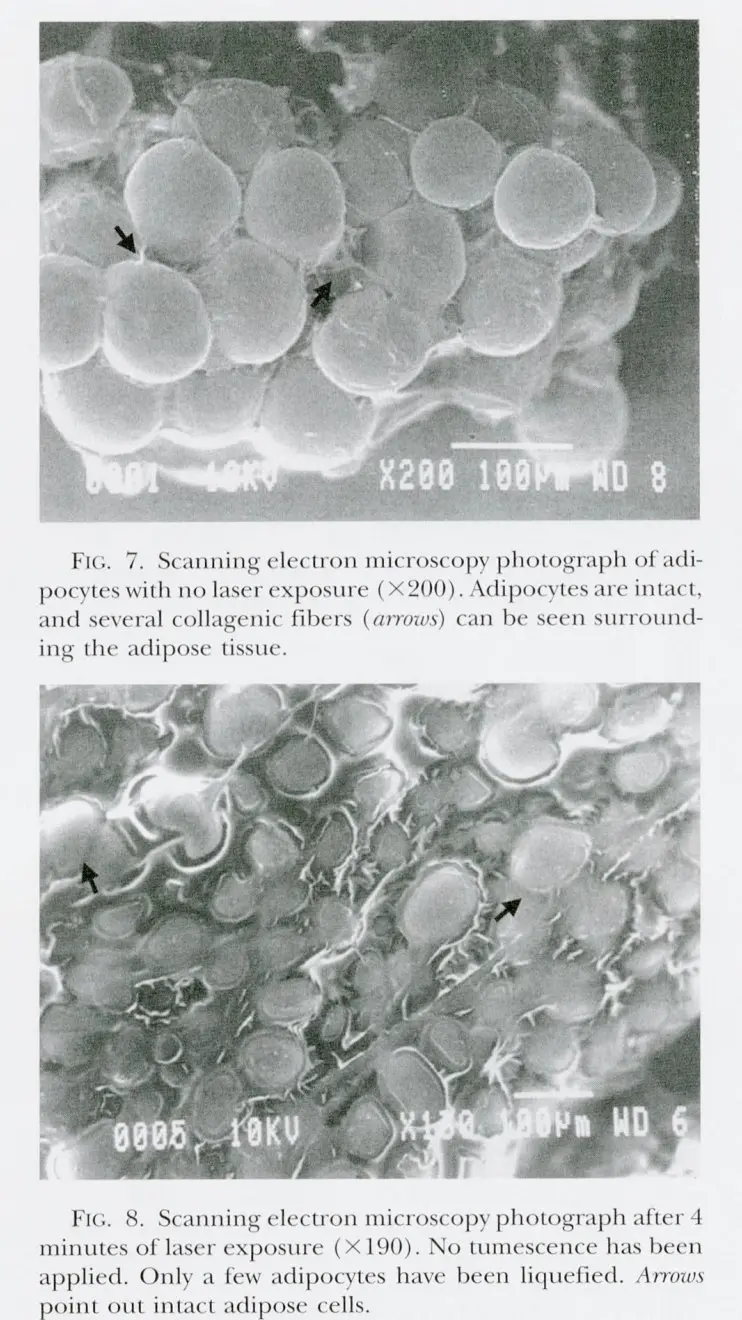 Diagram of the treatment opening temporary pores in a fat cell and releasing fat droplets