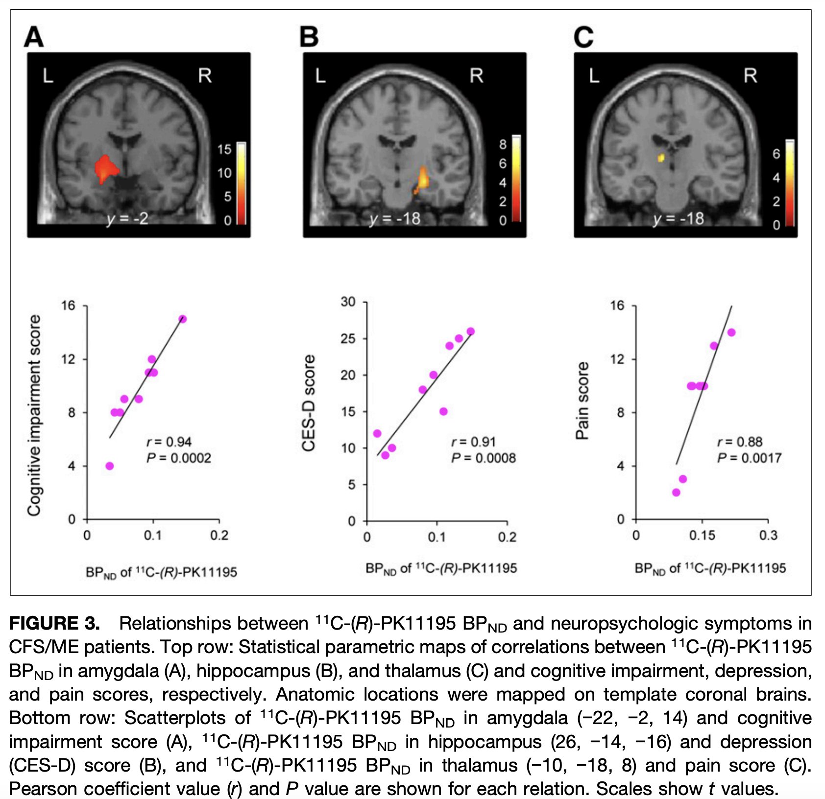 Brain scan image showing microglial activation linked to cognitive impairment and fatigue