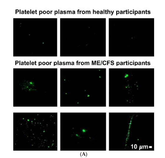 Research showing 10 times more microclots in chronic fatigue patients impeding blood flow
