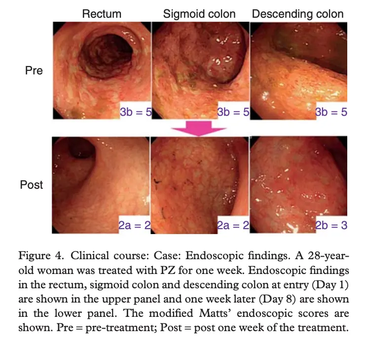 Before and after images showing remission of ulcers and inflammation in the gut one week after zinc carnosine