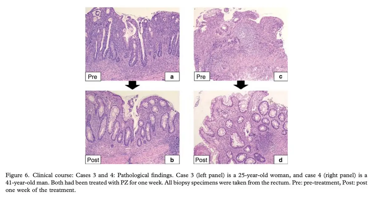 Histology of gut mucosa before and after zinc carnosine showing reduced inflammatory infiltrate and replenished goblet cells
